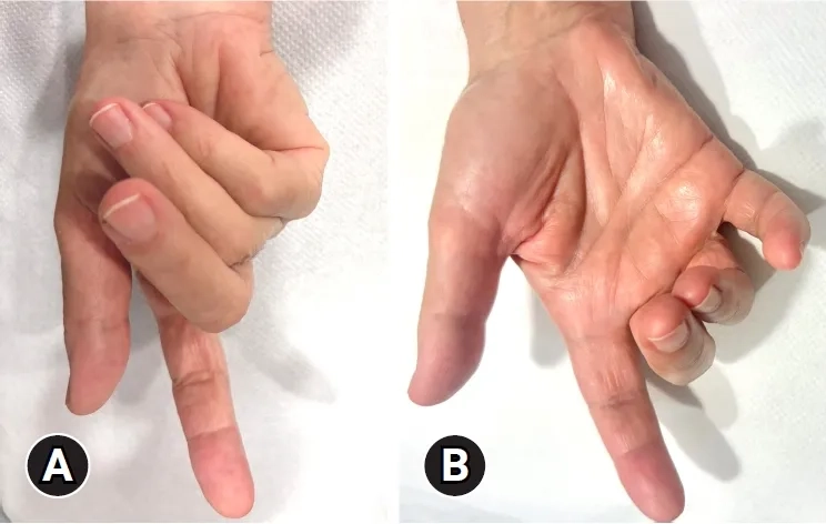 Deep brain stimulation as a dystonia treatment option