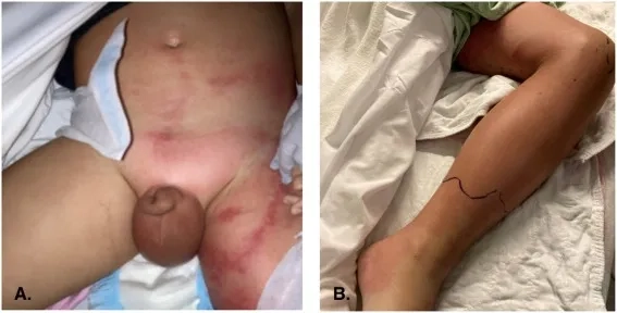 Common e coli infection symptoms to recognize