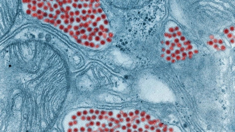 Neurological Disease can result from EEE infection