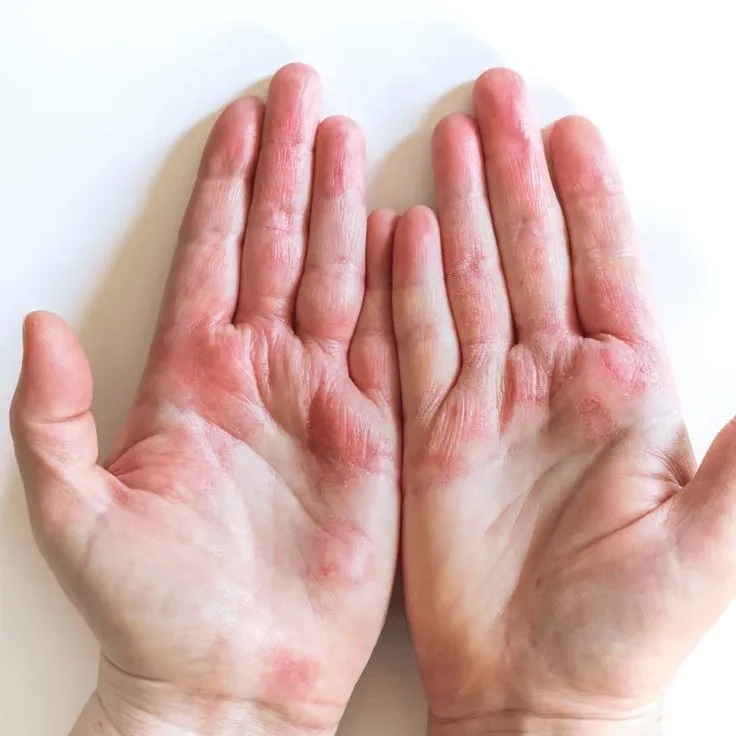 Close-up of dyshidrotic eczema on hands