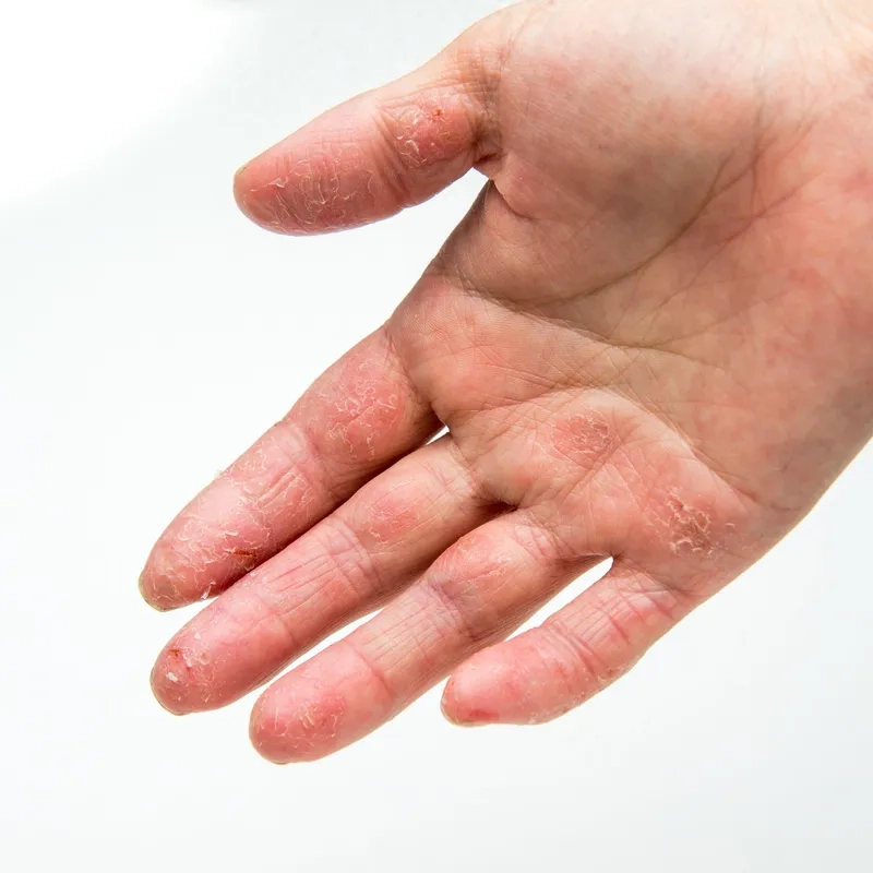 Effective methods for how to get rid of eczema