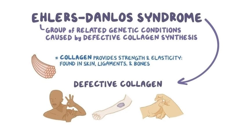 Clinical details of Ehlers-Danlos syndrome type 4