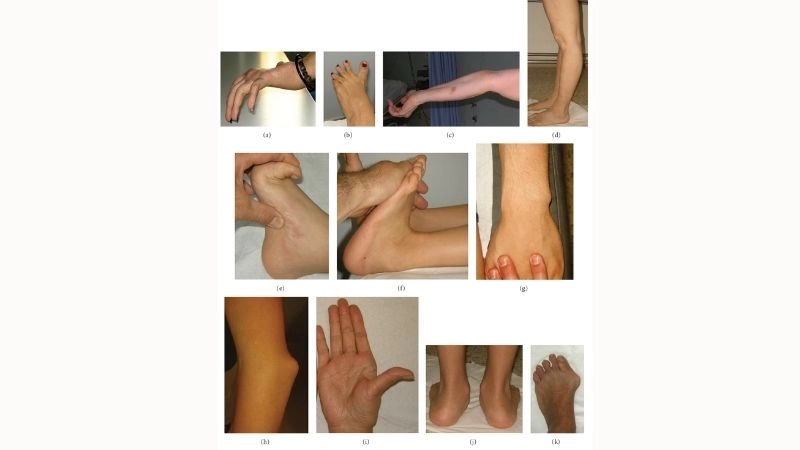 Arterial dissection and Ehlers-Danlos syndrome risks