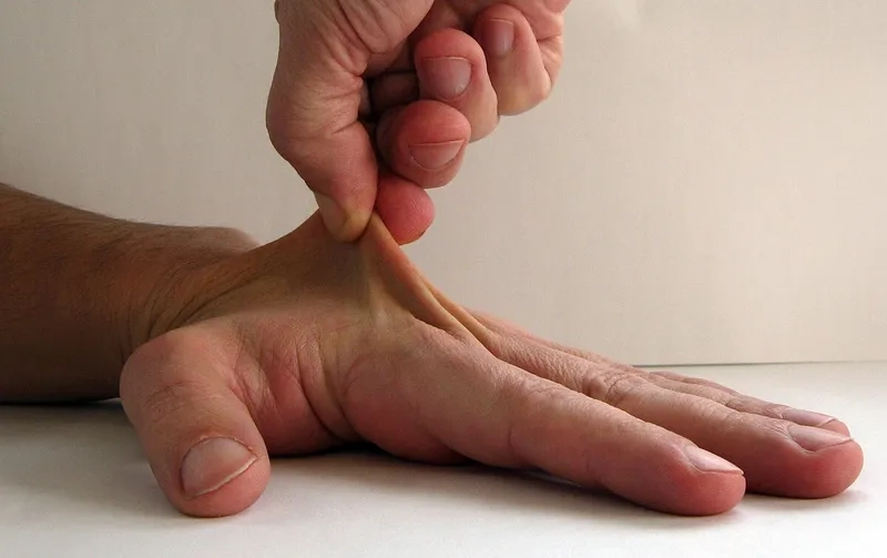 A doctor using the Beighton score to test a patient