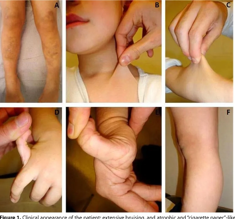 An infographic of common Ehlers Danlos Syndrome symptoms