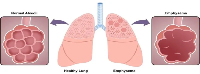 Recognizing common emphysema symptoms