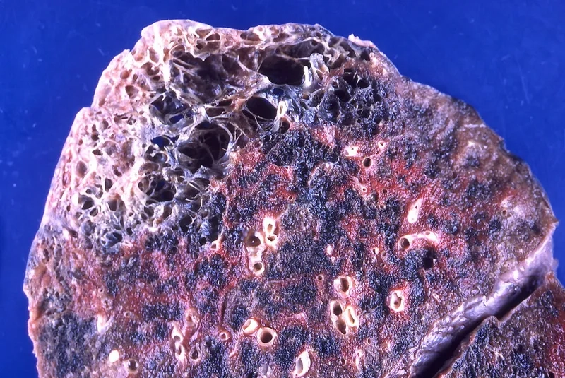 Patient receiving emphysema treatment