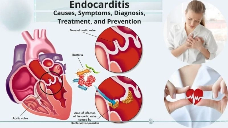 Endocarditis symptoms include fever, chills, fatigue