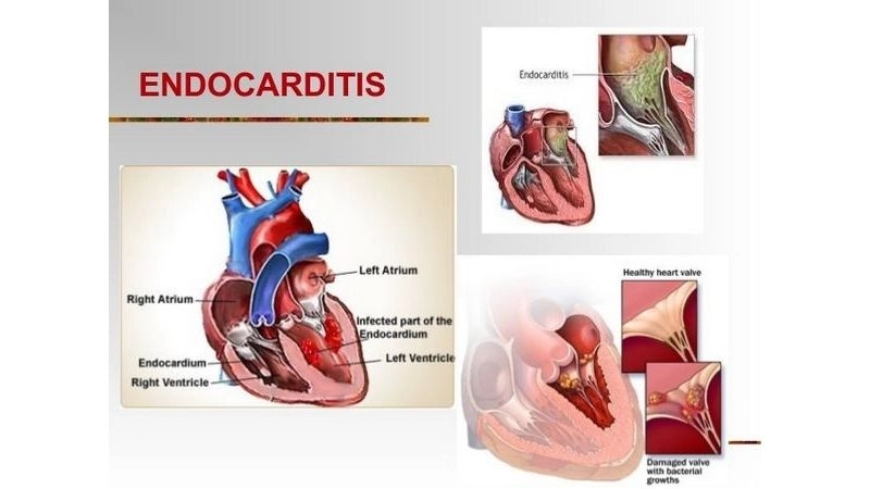 Bacterial endocarditis damages heart valves severely