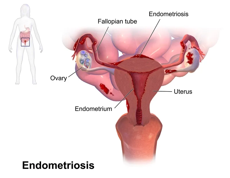 A doctor discussing common endometriosis symptoms with a patient