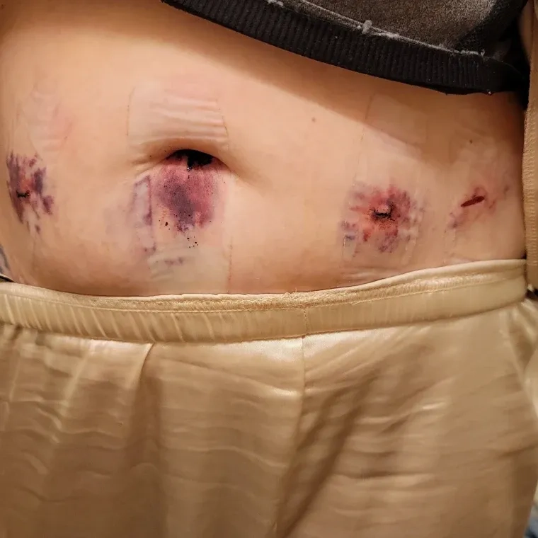 Anatomical illustration showing what is endometriosis