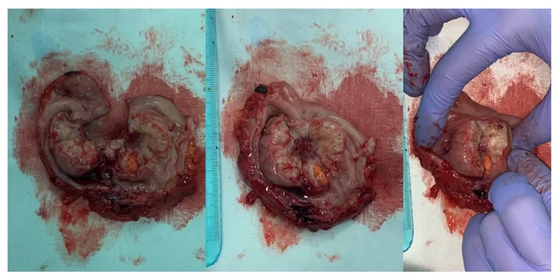 Woman using a heat pack to manage her endometriosis pain