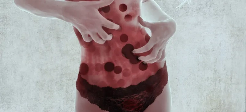 Diagram showing the four stages of endometriosis