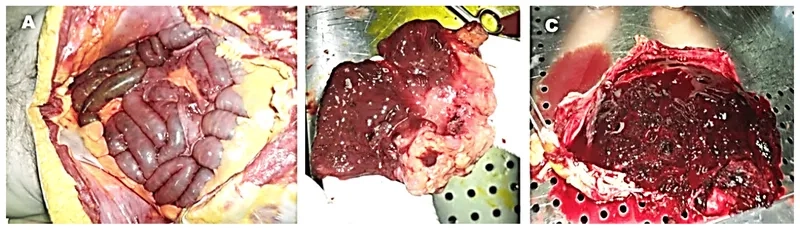 Exploring home remedies for pinworms