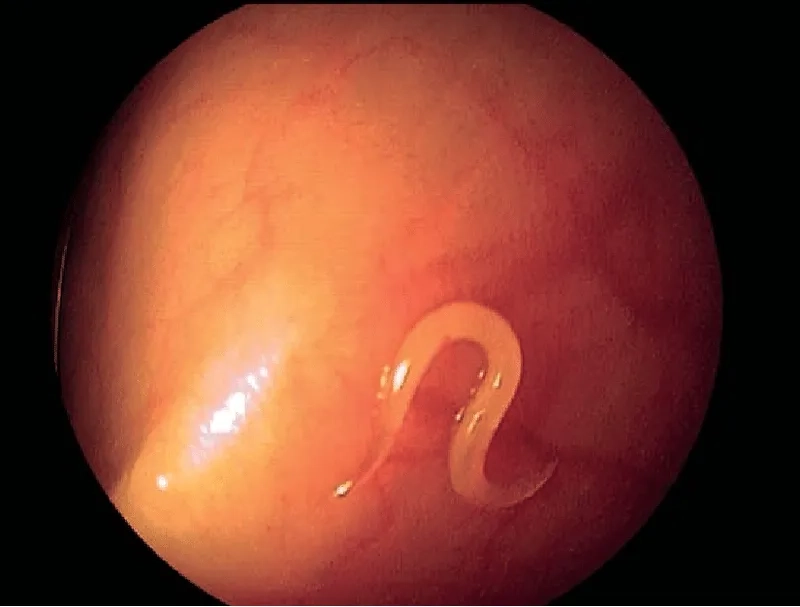 What do pinworms look like up close