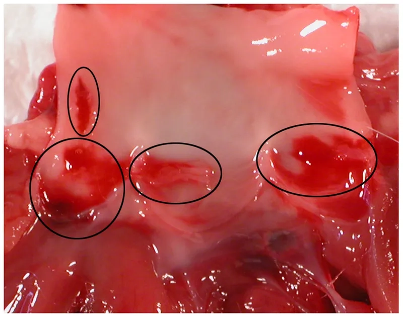 Key symptoms indicating a VRE bloodstream infection