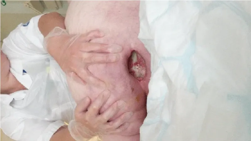 Clinical presentation of an Enterococcus faecium infection