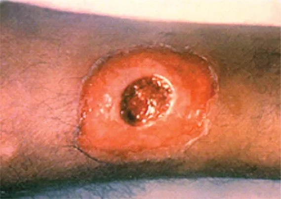 Discussing the contagious potential of Enterococcus bacteria