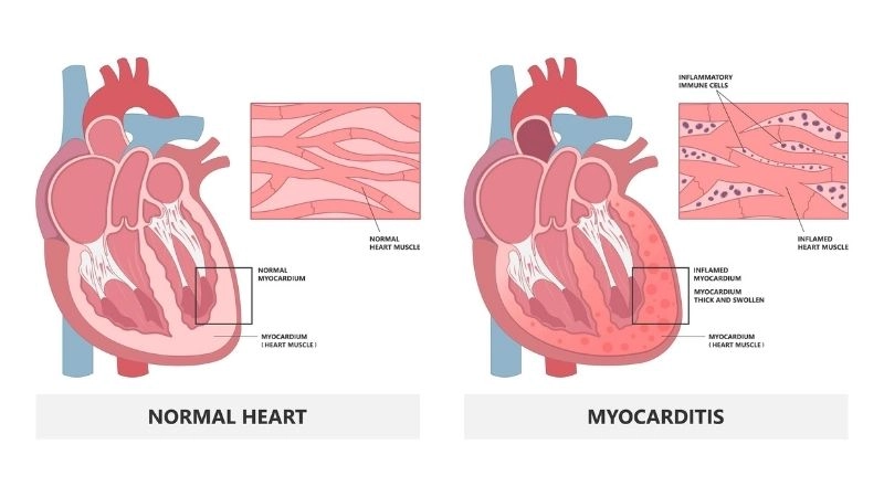 Eosinophilic myocarditis symptoms warning signs of rare inflammation