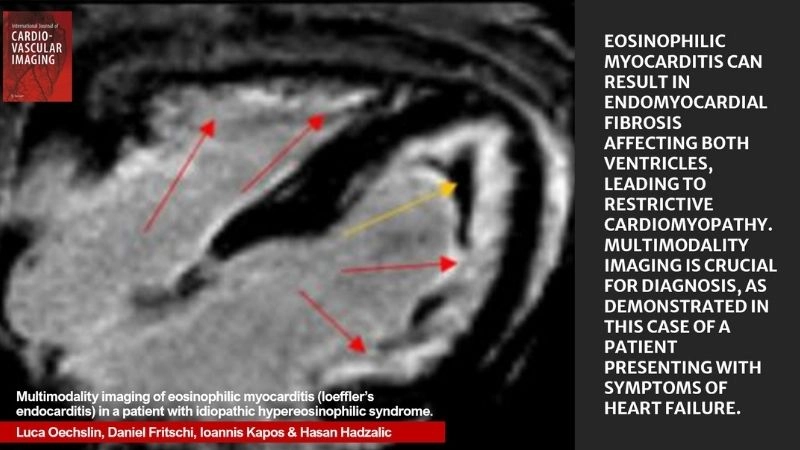 Eosinophilic myocarditis and drug reaction hypersensitivity link
