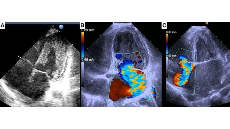 Eosinophilic myocarditis and parasitic infection infectious cause