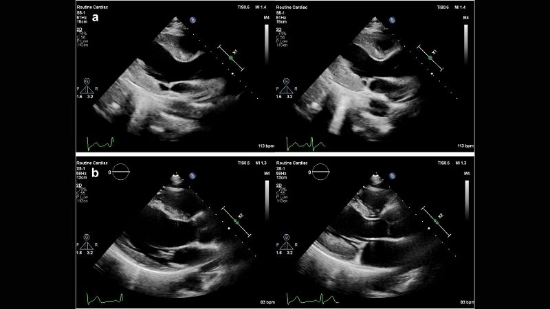 Eosinophilic myocarditis and hypereosinophilic syndrome serious overlap
