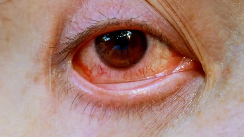 Epidemic Keratoconjunctivitis EKC prevention for eye health