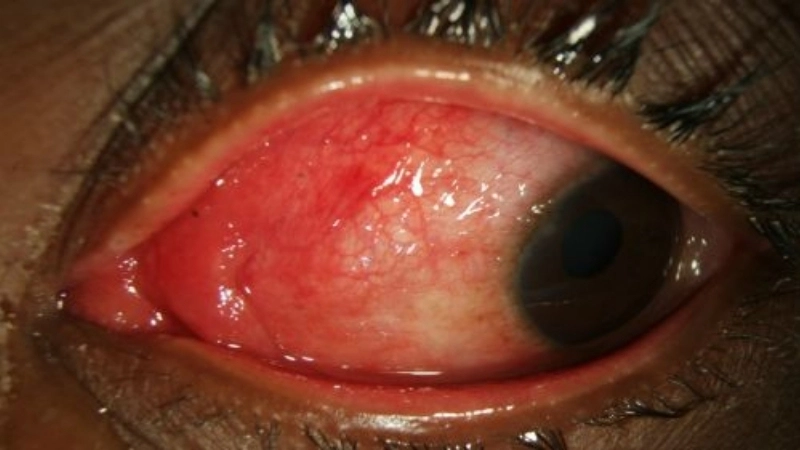 Epidemic Keratoconjunctivitis and adenoviral conjunctivitis care