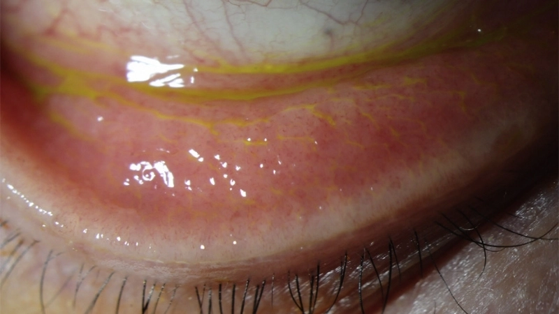 Epidemic Keratoconjunctivitis best treatment tips shared