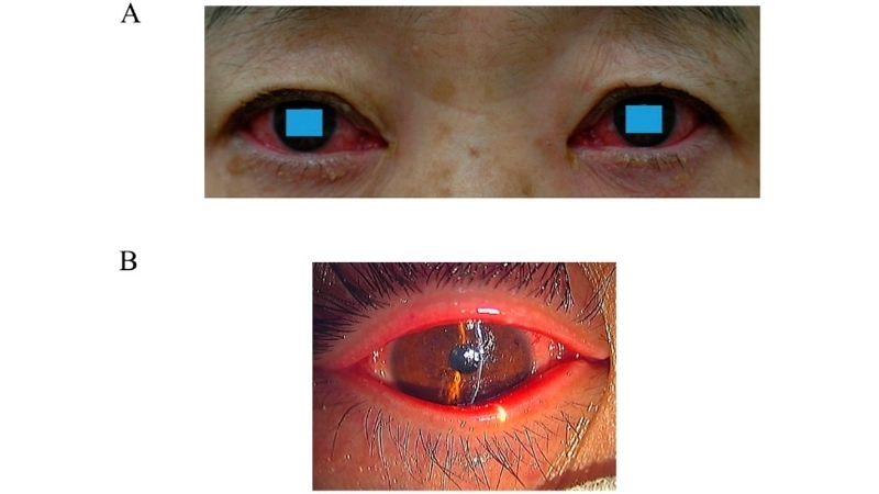Epidemic Keratoconjunctivitis often mistaken as pink eye