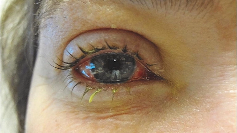 Epidemic Keratoconjunctivitis a severe type of conjunctivitis