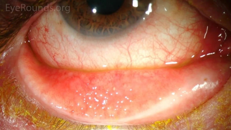 Epidemic Keratoconjunctivitis common viral eye infection
