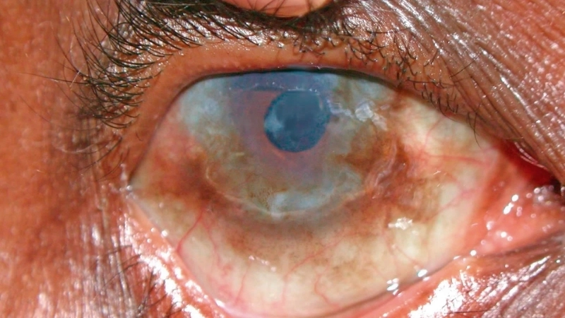 Epidemic Keratoconjunctivitis viral keratoconjunctivitis signs