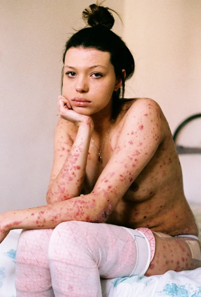 Junctional form of epidermolysis bullosa