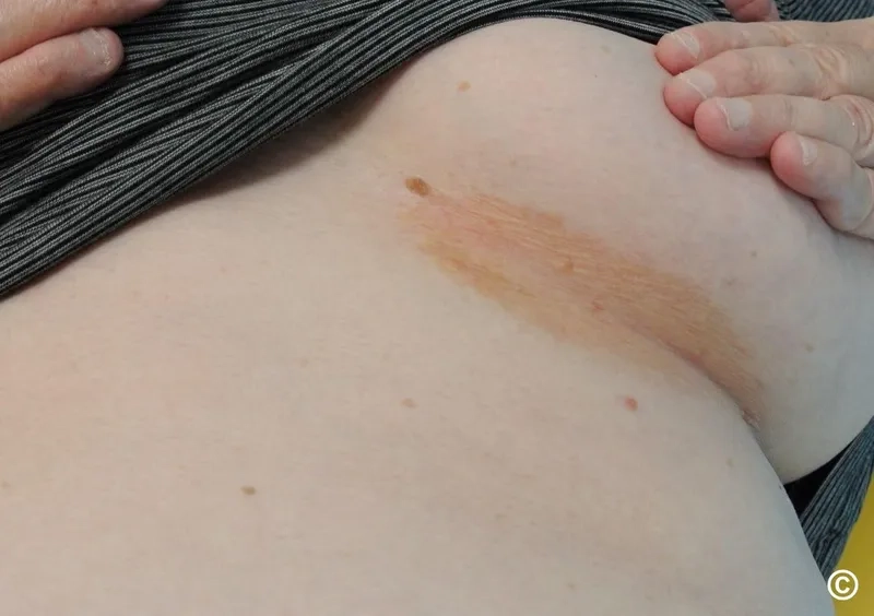 An effective Erythrasma treatment plan