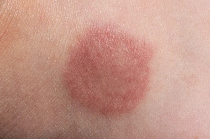 An explanation of what is Erythrasma