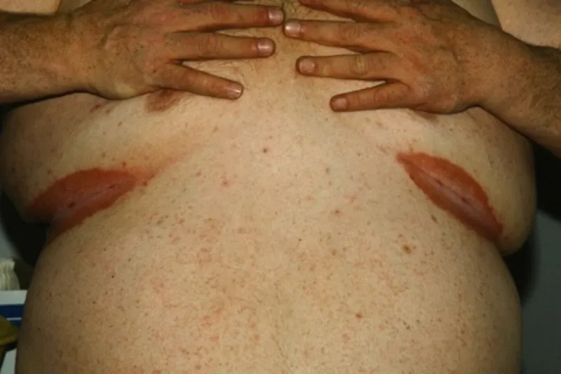 A Wood's lamp view of Erythrasma