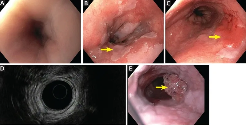 Difficulty swallowing shown in esophageal medical scan