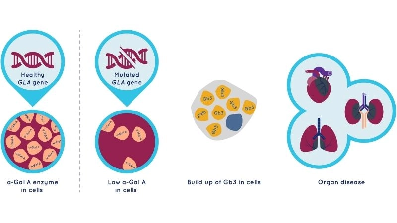 Fabry disease in women unique challenges