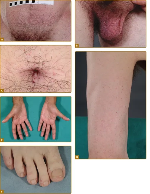 Fabry disease treatment and care approaches