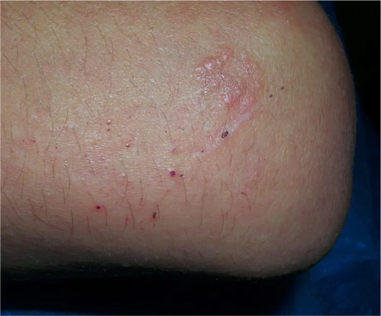 Fabry disease causes and risk factors