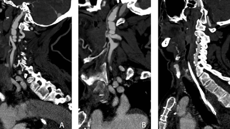 What is fibromuscular dysplasia and who gets it