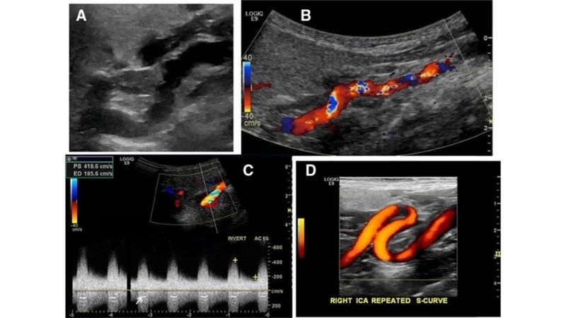 FMD and hypertension closely linked conditions