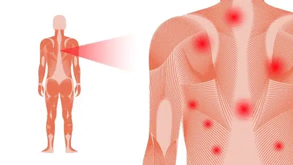 A diagram showing common fibromyalgia pain points