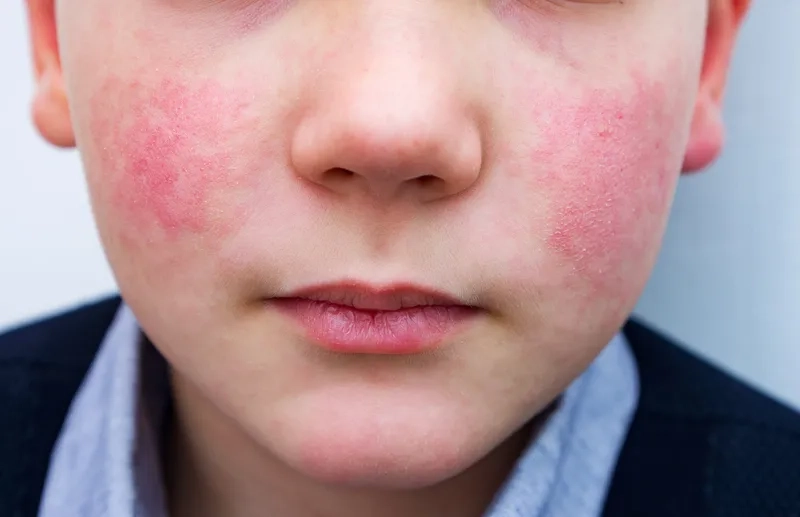Comfort care is the main treatment for fifth disease