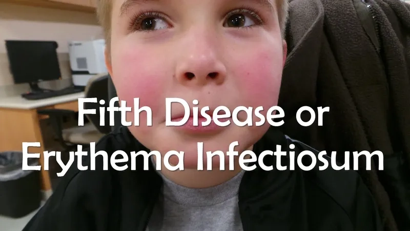 Supportive care for the treatment of fifth disease