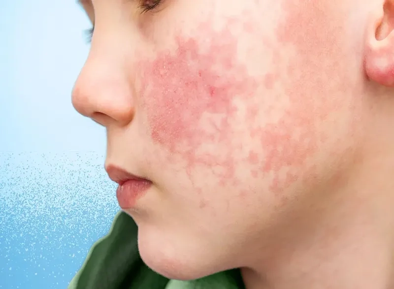 Using acetaminophen for fifth disease fever relief