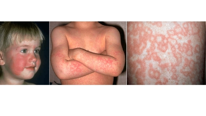 Monitor Fifth Disease (Erythema infectiosum) symptoms closely