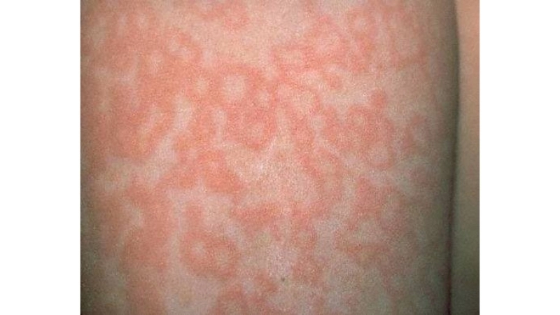 Spot Fifth Disease (Erythema infectiosum) rash early