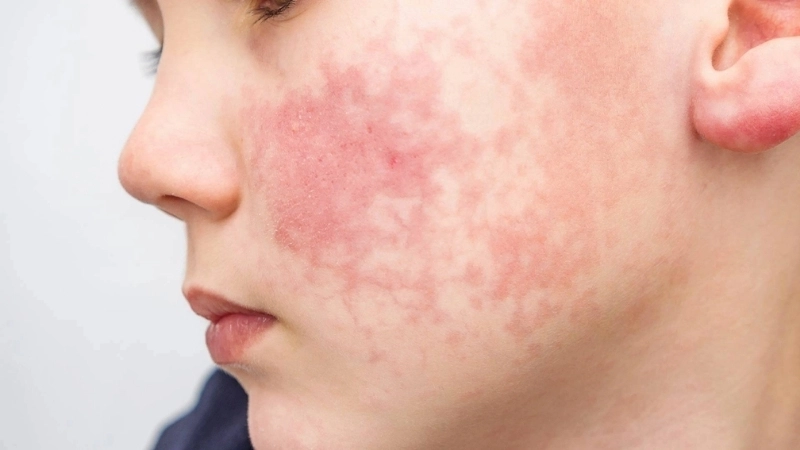 Learn Fifth Disease (Erythema infectiosum) pregnancy risks safely